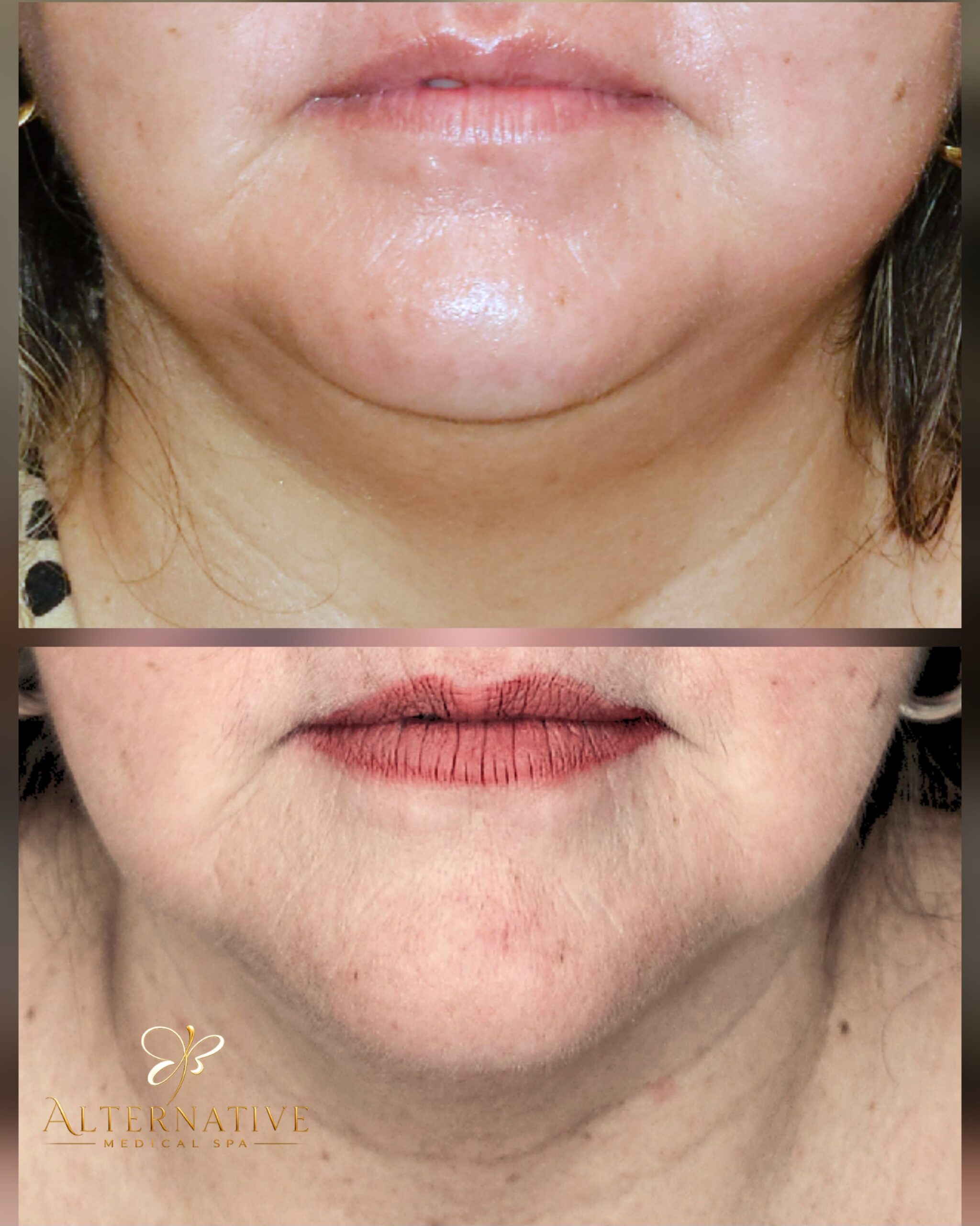 Resultado de tratamiento facial en Alternative Medical Spa