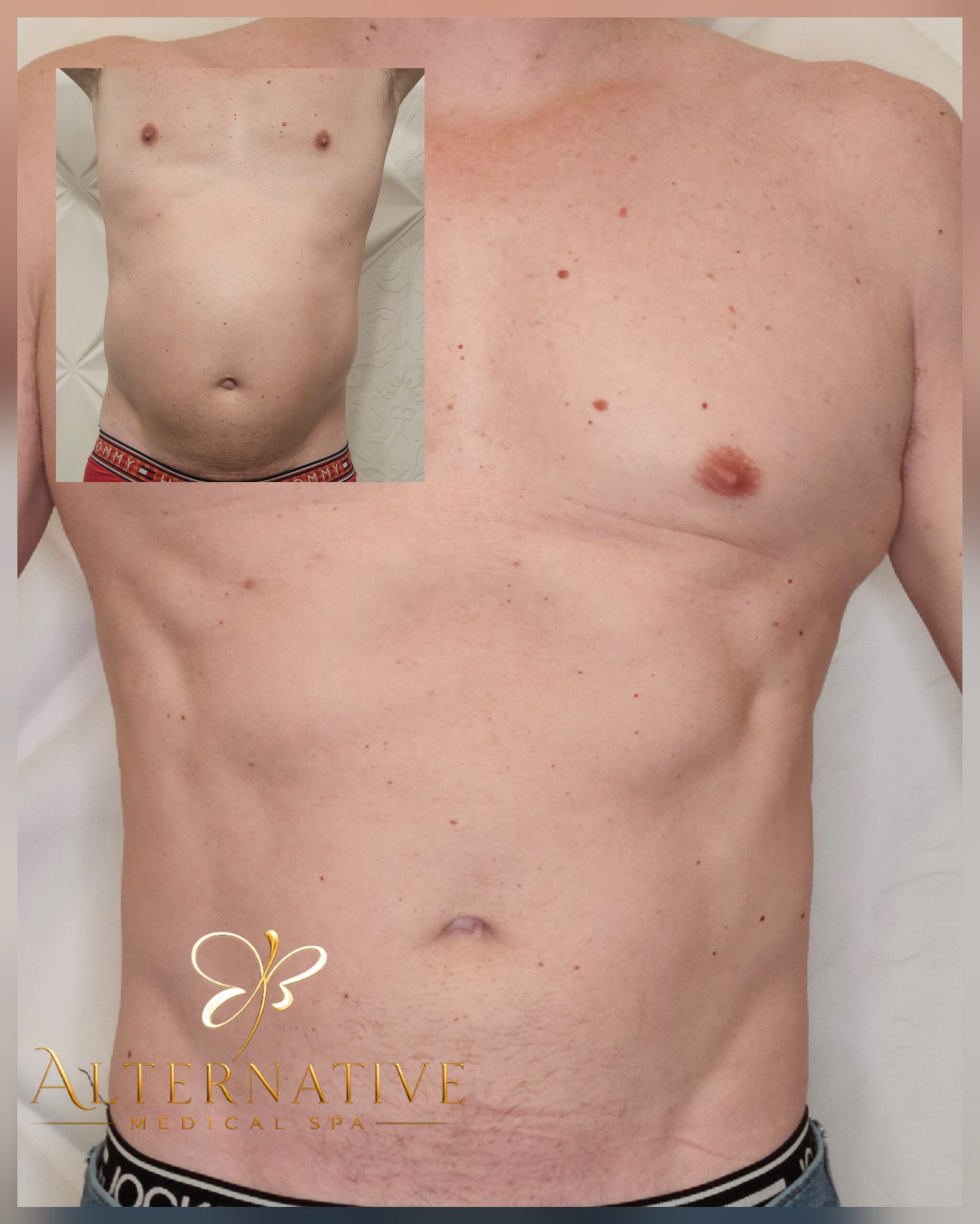 Resultado de tratamiento corporal en Alternative Medical Spa